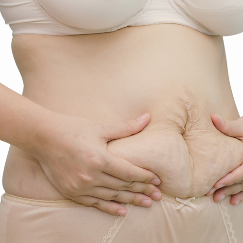 Entenda o que é diástase abdominal no pós-parto e quando é caso cirúrgico