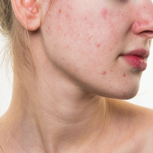 Tratamentos e causas para a pele com acne